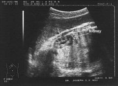 1. ______________ are useful for Fetal Development as can see whether RENAL development is normal.


 


2. In particular attention is paid to whether ____ SPOTS are seen in the KIDNEY as these represent _____ ______. If these cant be seen ...