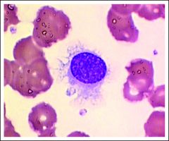 -peripheral smear : small - medium lymphocytes
       with hairy projections