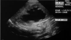 1. ULTRASOUND can also be useful in seeing whether the KIDNEY is full and _________ as seen in this case due to an ___________.


 


2. An ____________ in the URETER or further down can cause __________ which can result in more fluid in th...
