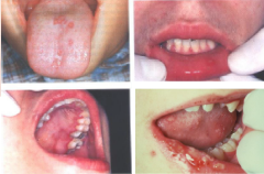 Infectious Viral Diseases: Primary Herpetic Gingivostomatitis