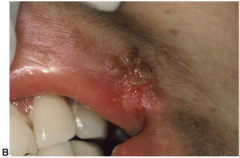 Infectious Viral Diseases: Herpes Labialis