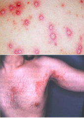 Infectious Viral Diseases: Primary Varicella-Zoster HSV-3