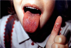 Infectious Viral Diseases: Hand-Foot-and-Mouth Disease