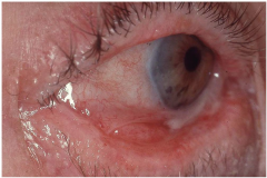 Noninfective Vesiculobullous (Autoimmune) Diseases: Ocular Mucous Membrane Pemphigoid