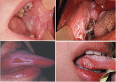 Traumatic Ulcers
