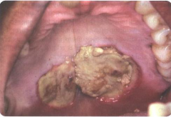 Traumatic Ulcers: Necrotizing Sialometaplasia