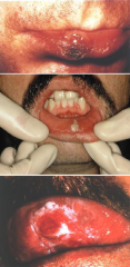 Ulcers from Infectious Agents: Syphilis