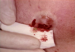 Ulcers from Infectious Agents: Actinomycosis