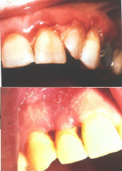 Ulcers from Infectious Agents: Necrotizing Ulcerative Gingivitis (NUG)