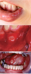 Recurrent Aphthous Ulcers