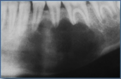 10-25 years old, asymptomatic, vital teeth, no expansion