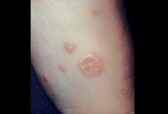 chronic skin condition with annular (circular) lesions, can by slightly pruritic

(can look like ringworm without scaling)