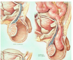 Hydrocele or congenital hernia