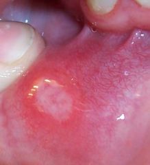 painful lesions in the oral mucosa with a grayish-white base and rim of erythema

can occur in isolation or be associated with Behcet's or Schwachman-Diamond Syndrome