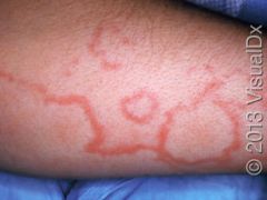 transient, erythematous, macular light-colored rash that is serpentiginous, margins progress with clear centers

associated with Rheumatic fever