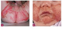 scaly and extremely erythematous rash in the premolar and perianal area that can desquamate