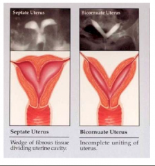 Divided uterus