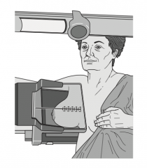 MedioLateral Oblique Mammogram, in which the breast is compressed in a 45 degree angle from the axilla to the lower sternum