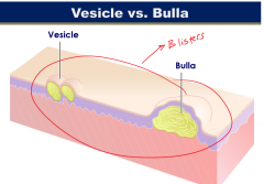 General term for a vesicle or bulla.
