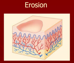 Depressed lesion due to loss of all or part of the epidermis.