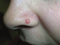 Mole -nevus (pic), acne