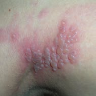 Chickenpox - vericella and shingles - zoster (pic)