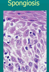 Intercellular edema of the epidermis. Ex; eczematous dermatitis