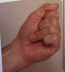 -test for FDP rupture


-ask pt to make fist


-if distal phalanx of one finger does not flex = (+) for ruptures FDP 