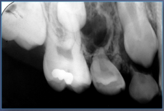 ~40 (4-80), female, asymptomatic, expansion, loose teeth