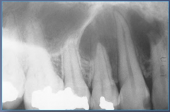 ~40 (4-80), female, asymptomatic, expansion, loose teeth