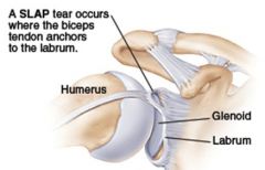 mobility > stability but


stabilized by anterior and posterior joint capsule, glenoid labrum, and long head of biceps mm (continuous with the labrum)