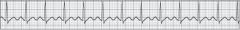 A patient with acute chest discomfort displays the cardiac rhythm shown below. Which of the following is the MOST detrimental effect that this rhythm can have on the patient?