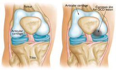-separation of the articular cartilage from the underlying bone (osteochondral fracture)


-usu involves medial femoral condyle near intercondylar notch and observed less frequently at femoral head and talar dome


Tx: if fracture is displaced the...