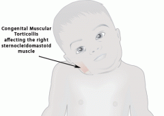 Extension, left side bending and right rotation * remember that right torticollis means the right SCM is tight