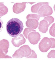 Polychromatic Normoblast
Smaller than basophilic normoblast
Cytoplasm is starting to look pinkish (because we are starting to accumulate hemoglobin)
Hemoglobin synthesized right from the beginning, but is really starting to accumulate now
Last sta...