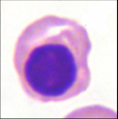Orthochromatic Normoblast
Cytoplasm is pink
Looks like an RBC, but with a nucleus
Very dense dark staining nucleus (nucleus is degenerating/dying & o longer active)
Last stage with a nucleus
Not dividing (pyknotic)
N:C ratio 1:1 to 1:2 (almost 50/...