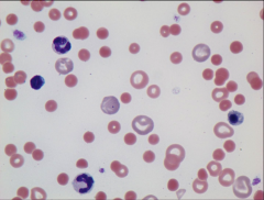 Reticulocytes cannot be definitively ID'd under Wright's stain
Need a retic stain
Cannot call it a reticulocyte if you haven't done a retic stain, can only call it a polychromatic cell (might be a retic, but it might not be)
Reticulocytes have cer...