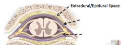  Extradural/ epidural space - location 
(wiki)