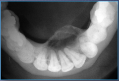Adolescents to middle-aged adults, expansible jaw lesion, displacement of teeth, facial deformities