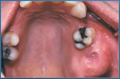 Adolescents to middle-aged adults, expansible jaw lesion, displacement of teeth, facial deformities
