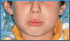 Early childhood, males, pigmented skin lesions, missing/displaced/delayed eruption of teeth