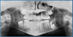 Early childhood, males, pigmented skin lesions, missing/displaced/delayed eruption of teeth