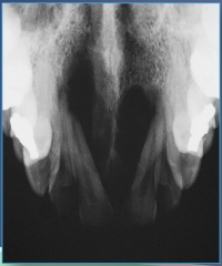 Adults, slow growing expansile mass, may or may not have pain or loose teeth