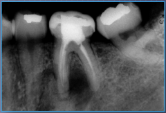 Middle-aged and older females, asymptomatic, usually vital teeth