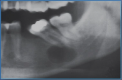 Middle-aged and older females, asymptomatic, usually vital teeth