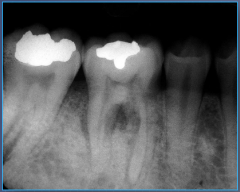 Young adult, pain and swelling, may have loose teeth, may have tooth ache, may have paresthesia