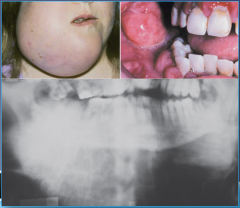Young adult, pain and swelling, may have loose teeth, may have tooth ache, may have paresthesia