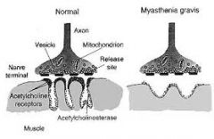 Myasthenia Gravis is autoimmune.  It debilitates function of neuromuscular junction, causing muscle weakness.  (Note the shallow "GRAVES" on image.)