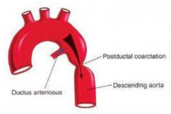 Constriction after it reaches Ductus Arteriosus

Alternative route: COLLATERAL CIRCULATION: Left subclavian-->Internal thoracic artery-->Anterior intercostal artery (1-6) anastomoses with Posterior intercostal artery (3-11)--> Descending Aorta/T...
