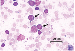 Ehrilichia chaffeensis/ Anaplasma phagocytophila. (famlia Ricketsias) 
Vector: garrapata
Pseudogripe con citopenias
Dx: Observación de mórulas en el citoplasma de neutrófilos en una extensión de sangre periférica